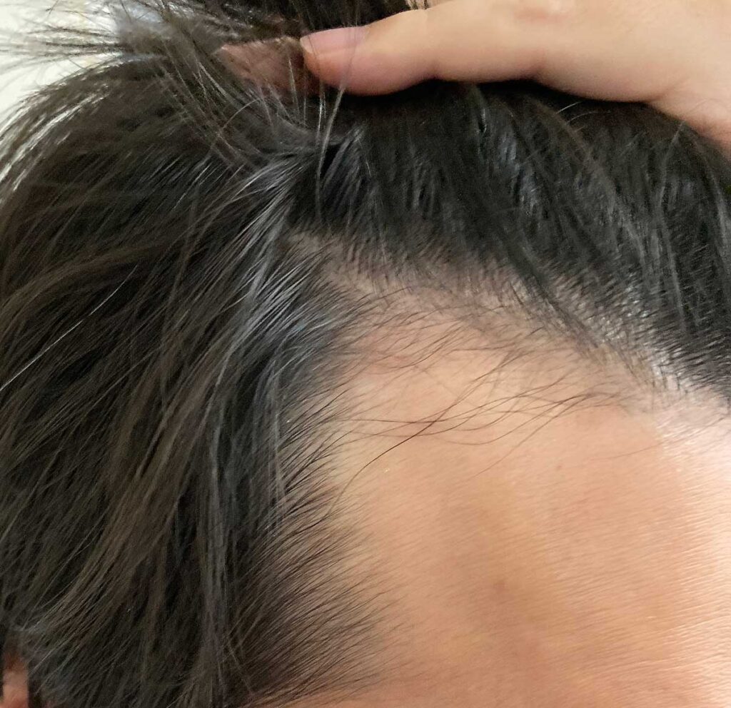 壮年性脱毛症における発毛剤 PHARMA CHOICE ミノキサン5 　使用レビュー